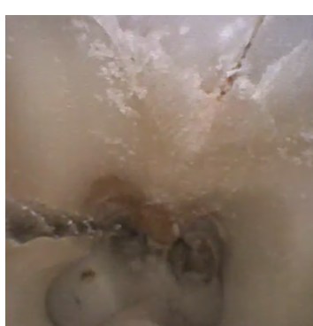 使用钻头扩张牙齿内部神经管的手术观察照片